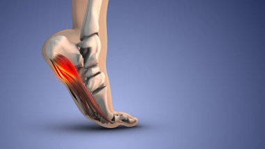 Plantar fasya bozukluğunun tıbbi animasyonu