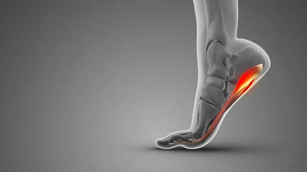 Stock image Plantar fascia dysfunction medical concept