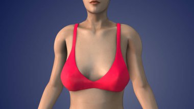 Göğüs gerdirme ameliyatına mastopeksi de denir.