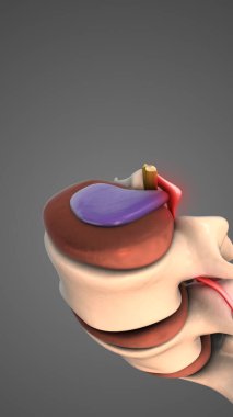Bel omurunda fıtık diski var.