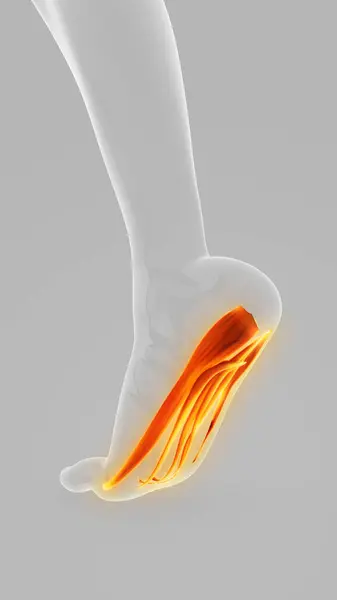 stock image Plantar Fascia Tissue Overload Dysfunction Disorder