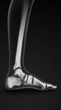 Akut ayak bileği bağı gerginliği ve ağrı durumu