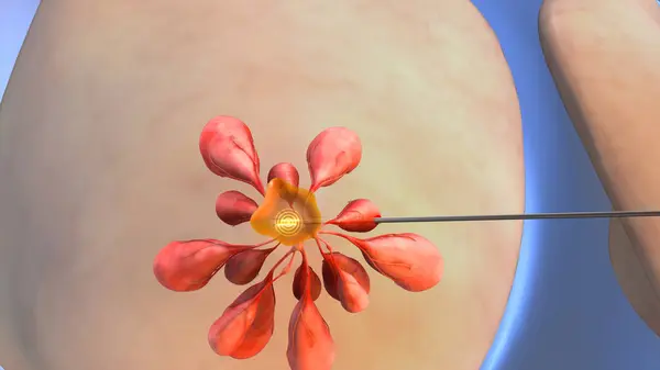 stock image Breast cancer nodule treatment medical animation