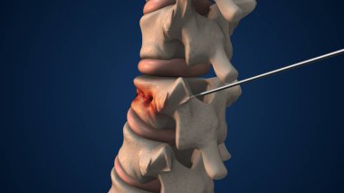 Tıbbi Çimento veya Vertebroplasti ile Omurilik Kırığı