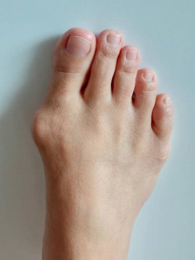Hallux valgus, Foot Bunions, Bump.