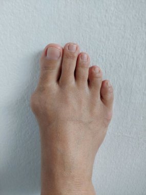 Hallux valgus, Foot Bunions, Bump.