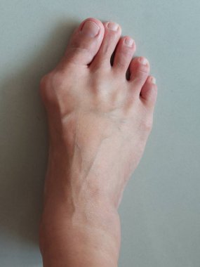 Hallux valgus, Foot Bunions, Bump.