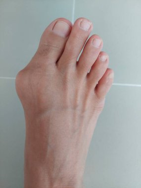 Hallux valgus, Foot Bunions, Bump.
