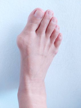 Hallux valgus, Foot Bunions, Bump.