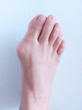 Hallux valgus, Foot Bunions, Bump.