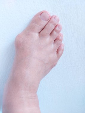 Hallux valgus, Foot Bunions, Bump.