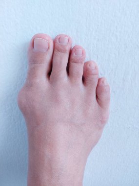 Hallux valgus, Foot Bunions, Bump.