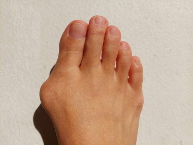 Hallux valgus, Foot Bunions, Bump.