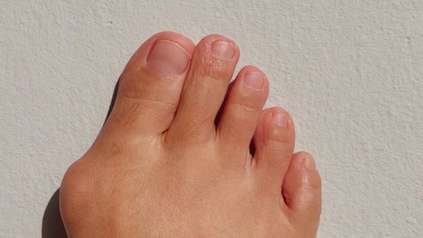 Woman Right Foot Hallux Valgus Foot Bunions Bony Bump — Stock Video