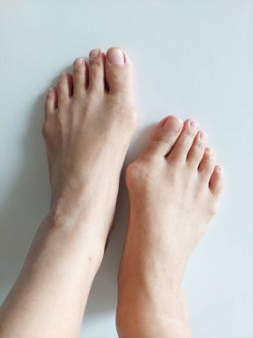 Hallux valgus, nasır, kemik şişliği olan kadın ayakları.  