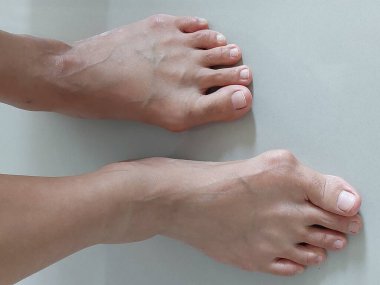 Hallux valgus, nasır, kemik şişliği olan kadın ayakları.  