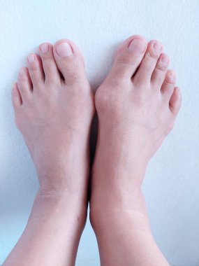 Hallux valgus, nasır, kemik şişliği olan kadın ayakları.  