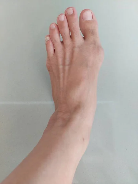 Een Vrouw Linkervoet Met Hallux Valgus Foot Bunion — Stockfoto