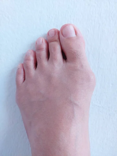 女性が左足にハラックスバルガス足ブニオン — ストック写真