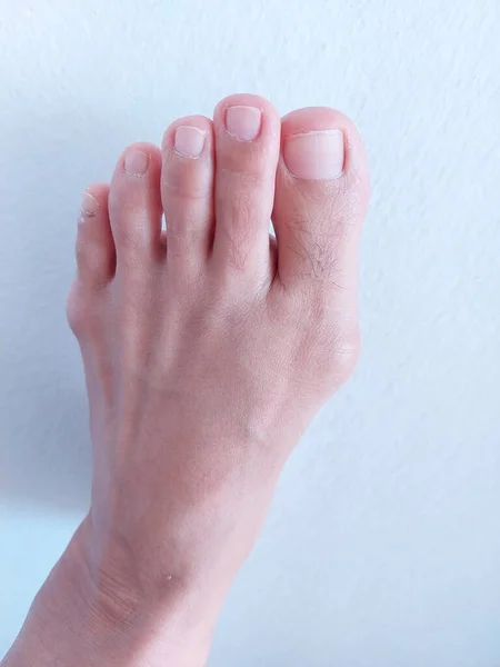 Woman Left Foot Hallux Valgus Foot Bunions — Stock Photo, Image