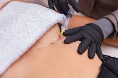 Ozon kullanarak estetik tedavi yöntemi. Kadın, iyileşme sürecini hızlandırmak için estetik ameliyat sonrası ozon uyguluyor.