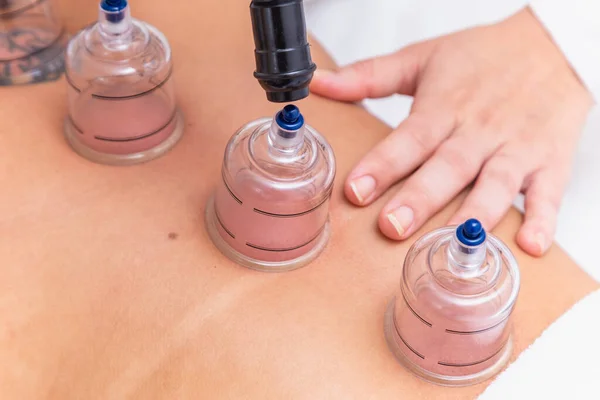Woman Lying Her Chest Cupping Treatment Her Back Woman Doing — Stock Photo, Image