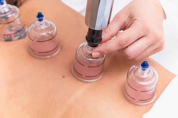 Woman Lying Her Chest Cupping Treatment Her Back Woman Doing — Stock Photo, Image
