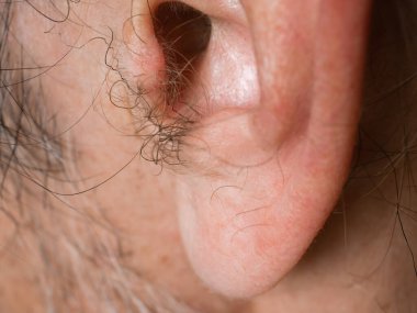 Kulak memesinde ve kulak kanalında orta yaşlı bir adamın kılları çıkıyor.