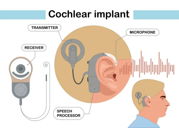 Cochleaire Implantaat Apparaat Elektrisch Stimuleert Zenuw Medische Hulp Oorgeluidsgolf Volwassenen — Stockvector