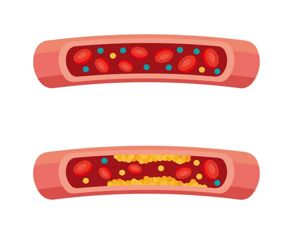 Imagen Ilustrativa Colesterol Vasos Sanguíneos — Vector de stock