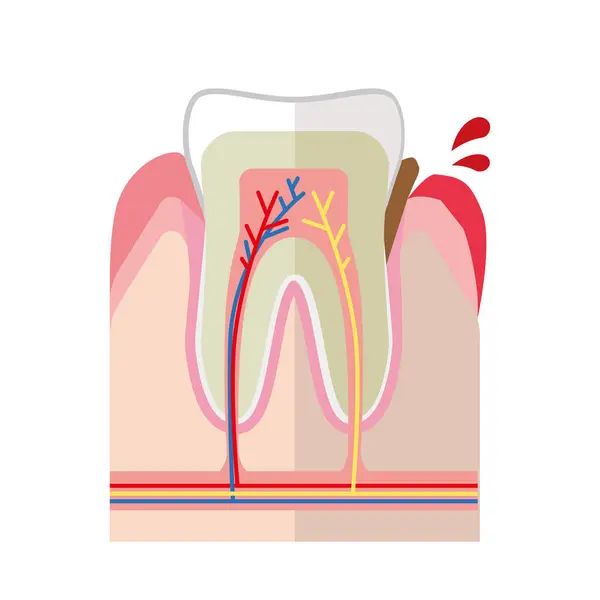 Denti Denti Sani Con Malattia Parodontale — Vettoriale Stock