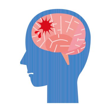 İntraserebral kanamanın resim çizimi