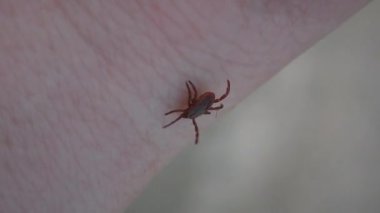 Tehlikeli bir parazit. Sert kene veya ölçek kenesi (Ixodes sp.) İnsan derisinde sürünüyor..