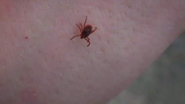 Tehlikeli vektör Sert kene veya Ölçek kenesi (Ixodidae) insan derisi üzerinde sürünür.