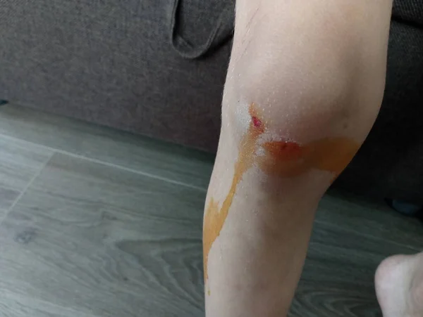 The knee injury of a little boy is treated with an antiseptic on the background of a dark floor and a soft brown sofa. Damage to the skin covering of the child\'s leg and providing assistance and treat