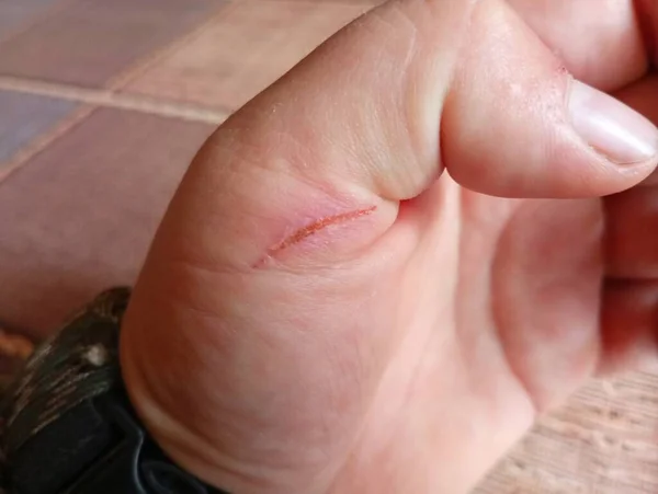 A scar from a small cut is not on a human palm. A wound on the skin that is healing.