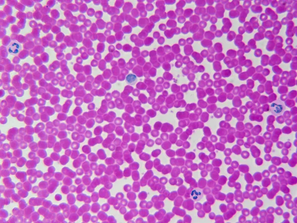 Vér Mikroszkóp Alatt Vörös Fehér Sejtek Nagy Nagyításban — Stock Fotó