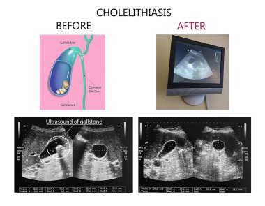 Ultrasonography image of gallbladder with gall stones at upper abdomen. Gallstones concept - anatomy of cholelithiasis