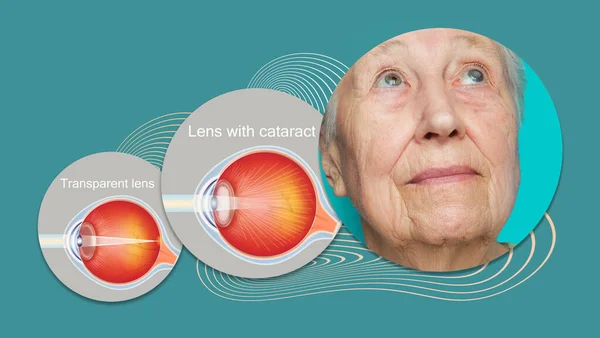 Cataract concept. Senior woman\'s eye, closeup and cataracts and healthy eye detailed structure. Collage