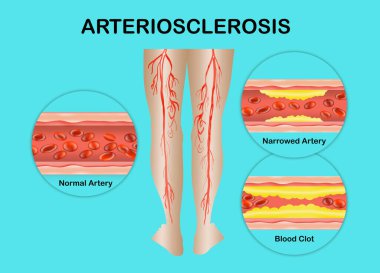 Human legs. Artery with blood cells desease. Concept of dry skin, old senior people, varicose veins and DVT.