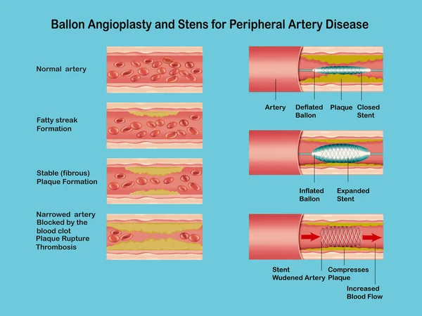 Angioplasty. Stent Implantation. Deflated balloon catheter inserted into a coronary artery narrowed by plaque. the balloon is inflated, compressing the plaque against the artery wall