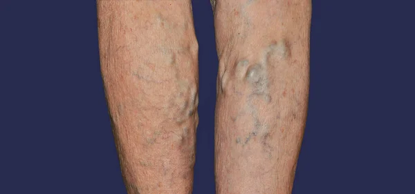 Varicose Veins Female Legs Phlebology Dvt Old Age Sick Woman — Stock Photo, Image