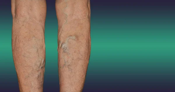 Varicose Veins Female Legs Phlebology Dvt Old Age Sick Woman — Stock Photo, Image