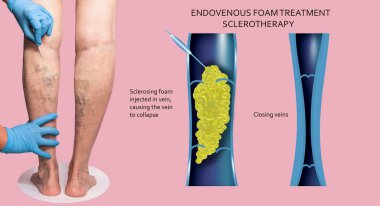 Endovenous laser treatment for varicose veins - foam sclerotherap concept. Before and after. Structure of vein clipart