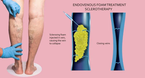 Endovenous laser treatment for varicose veins - foam sclerotherap concept. Before and after. Structure of vein