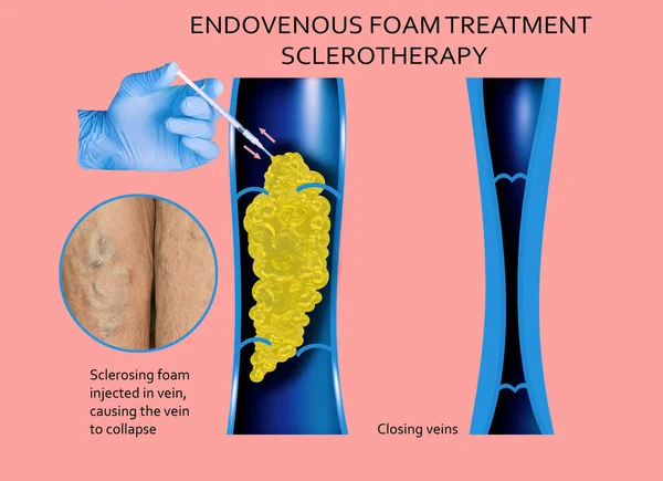 Endovenous laser treatment for varicose veins - foam sclerotherap concept. Before and after. Structure of vein