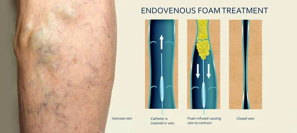 Endovenous laser treatment for varicose veins - foam sclerotherapy concept. Before and after. Structure of vein