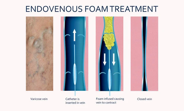 Endovenous laser treatment for varicose veins - foam sclerotherapy concept. Before and after. Structure of vein