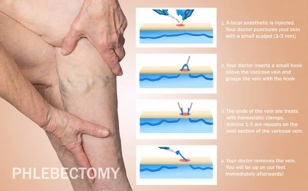 Ambulatory Phlebectomy Treatment for varicose vein. AP is a surgical procedure designed to allow outpatient removal of bulging varicose veins.
