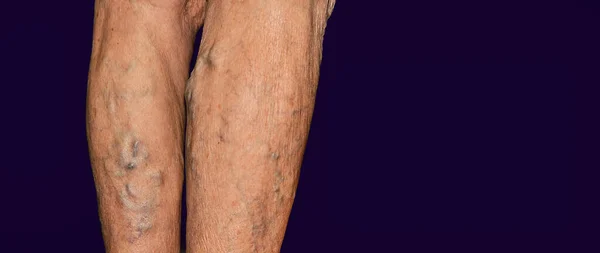 Varicose veins on a female legs. Phlebology and DVT. The old age and sick of a woman. Varicose veins on a legs of old woman. The varicosity, spider veins, edema, illness concept. Senior pensioner